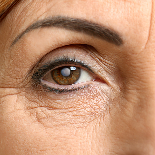 ¿Cómo se relacionan las cataratas y la menopausia? ¿cómo cuidarte?